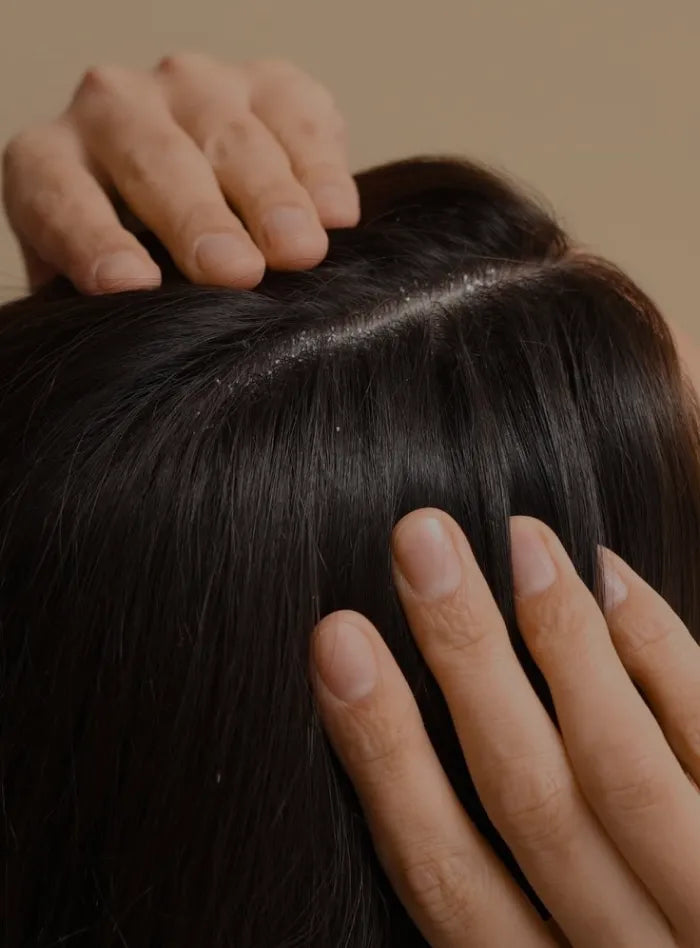Dandruff Reduced